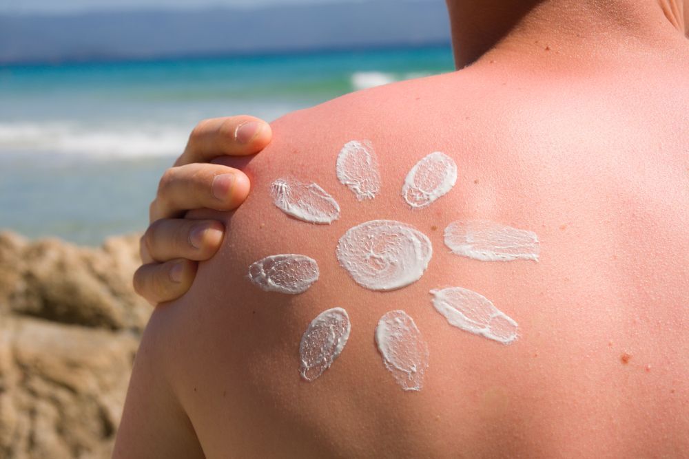 Quemaduras de sol